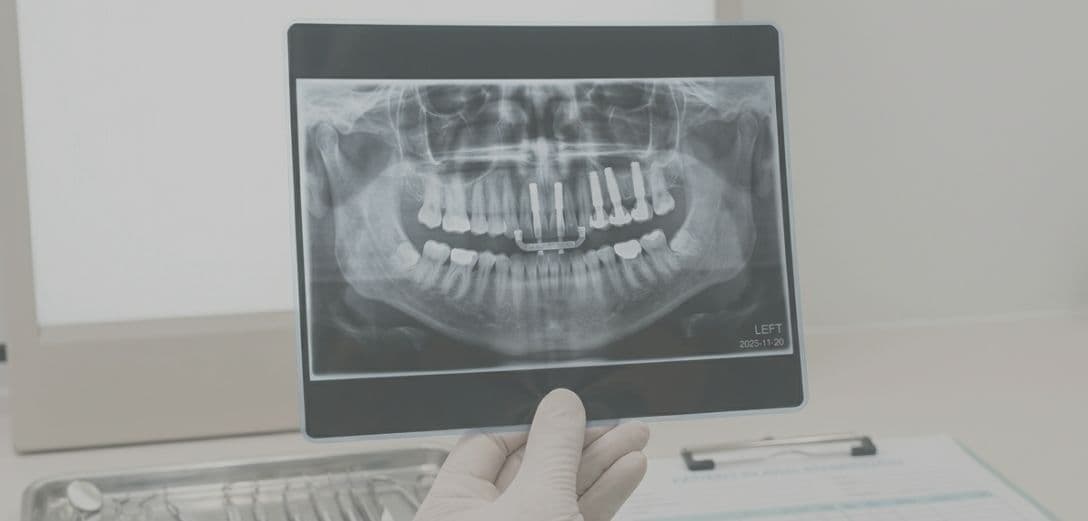 Implantes Cigomáticos. Cirugía: Zygoma Cuádruple