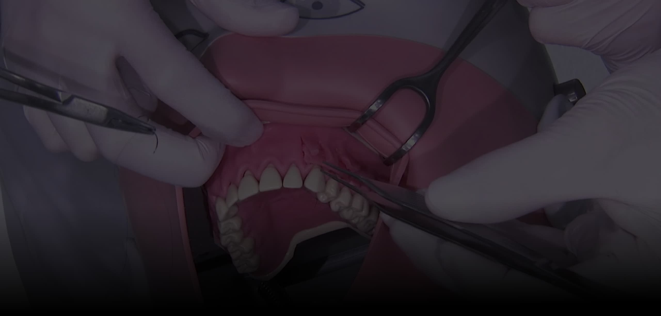 Periodontal Plastic Surgery