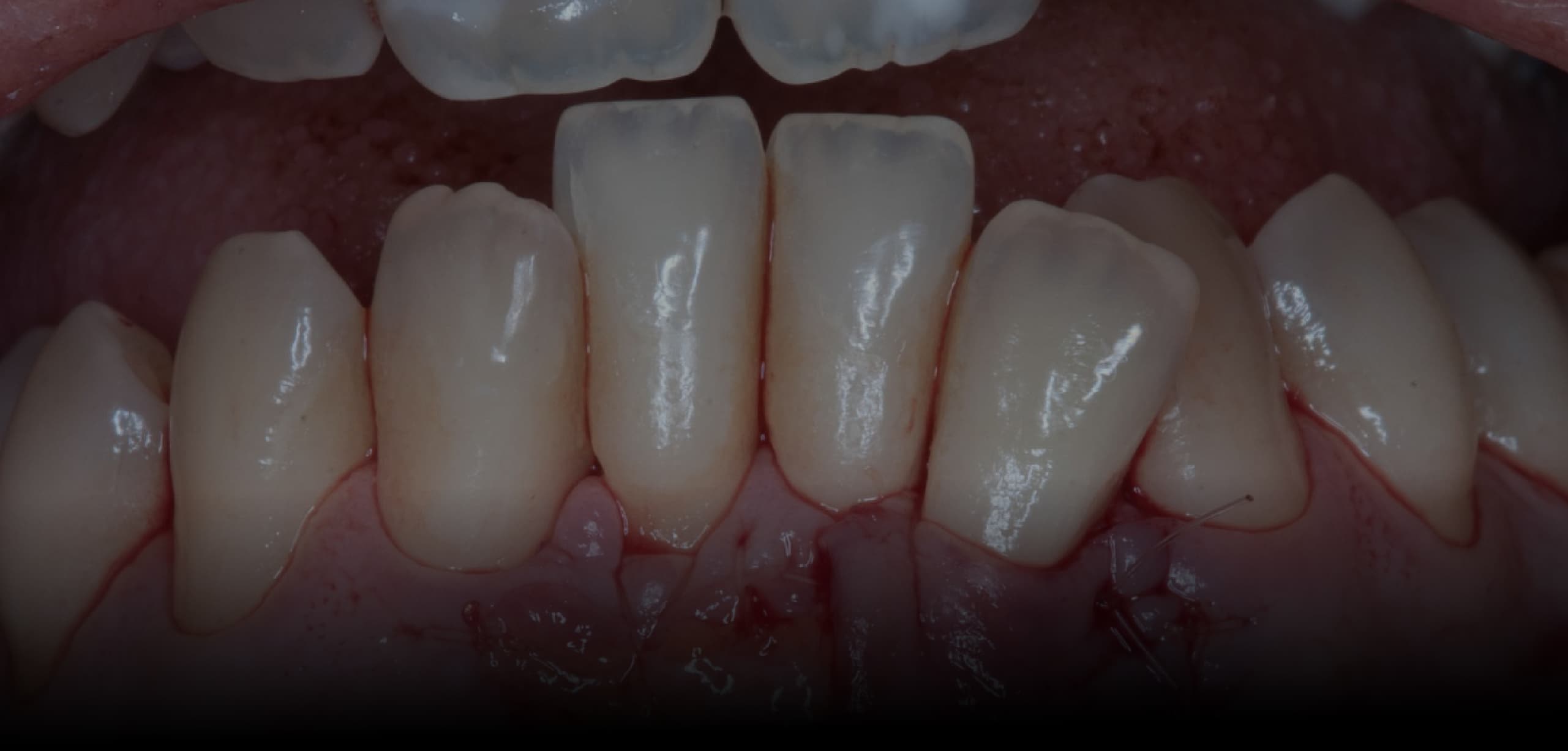 Curso Práctico de Cirugía Mucogingival