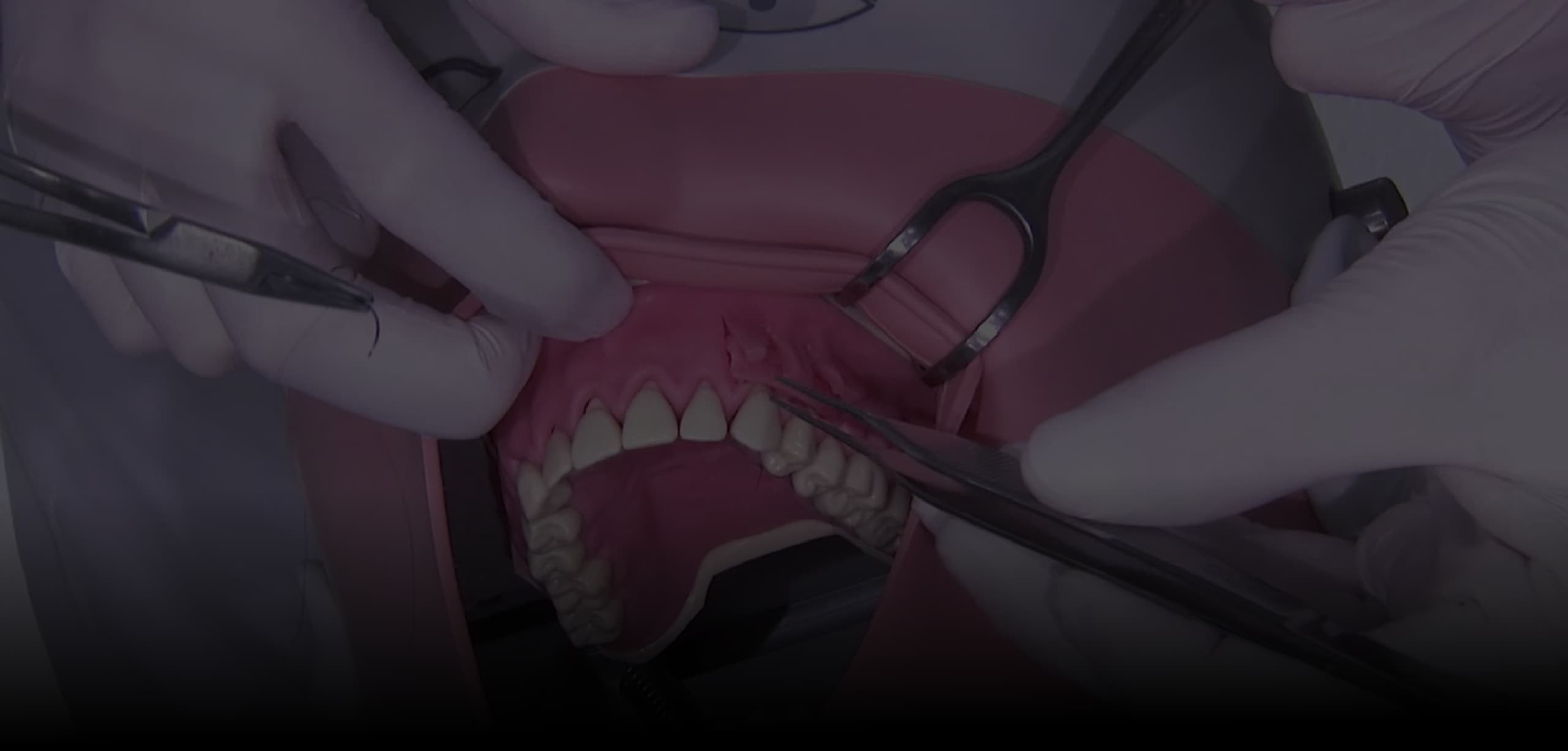 Atlas of Plastic and Regenerative Implant Surgery in the Aesthetic Area