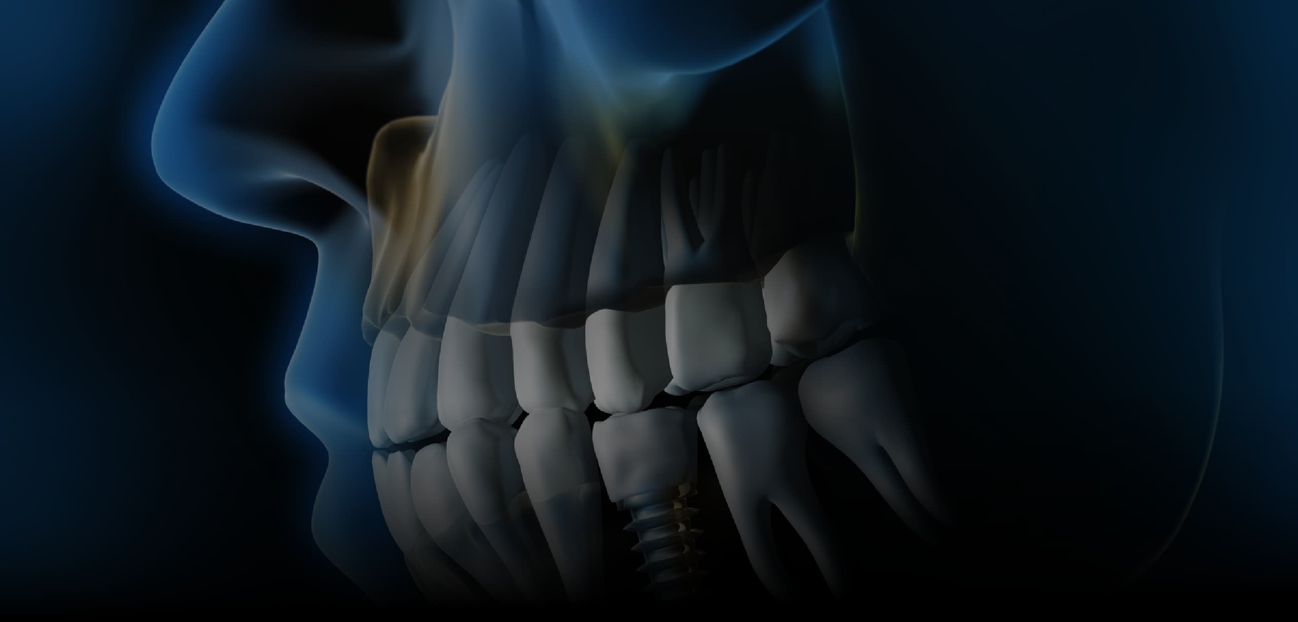 Complications in Implantology