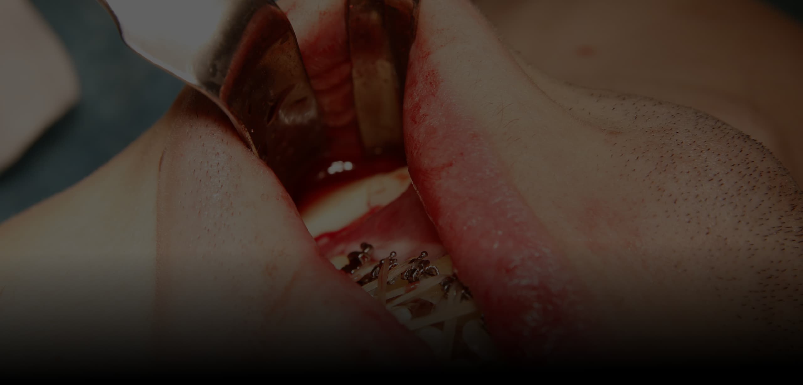Máster en Cirugía Implantológica y Periodontal