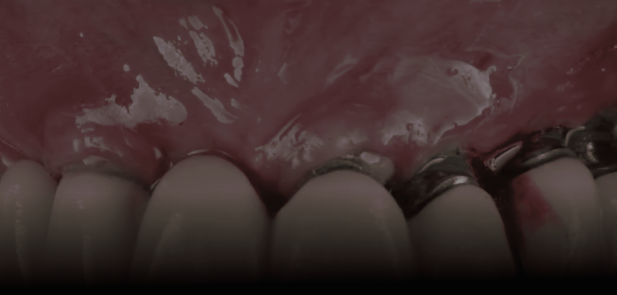 Unfolding Peri-Implantitis